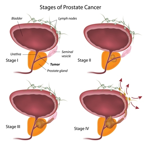 Stages of Prostate Cancer